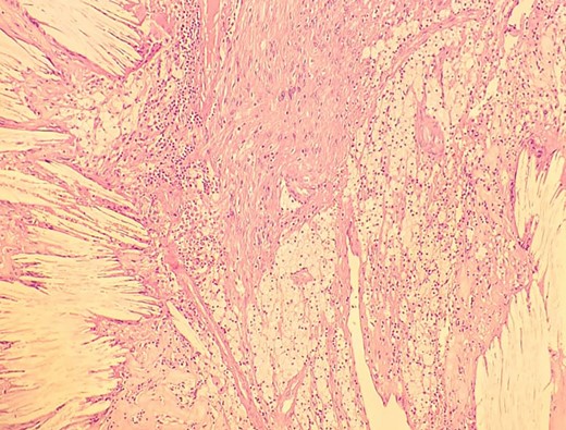 Low-resolution 200x H&E histopathology of the tumour showing foamy macrophages and cholesterol clefts suggestive of degenerative changes, suggestive of ancient schwannoma.
