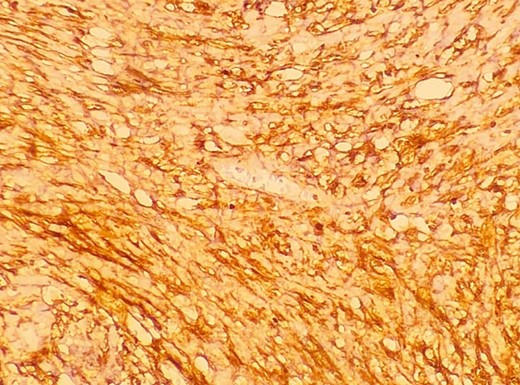 A low-resolution 200x S-100 immunostained histopathology image of the tumour showed strongly positive staining.