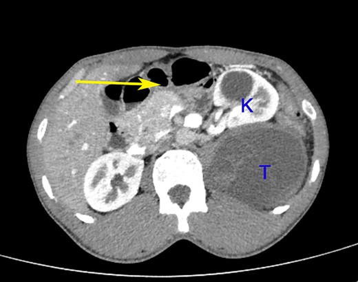 A contrast-enhanced CT scan of the abdomen at the level of the L2 vertebra shows a paravertebral tumour (T) posterior to the kidney (K). The tumour shows peripheral enhancement and inhomogeneous intra-tumoural contrast enhancement. The left colon is pushed to the right and anteriorly (arrow).