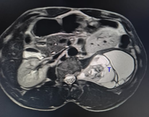The tumour (T) shows a high-intensity signal on a T2-weighted MRI.
