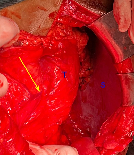 Intraoperative photograph showing the left colic vessels are splayed (arrow) by the tumour (T). S: spleen.