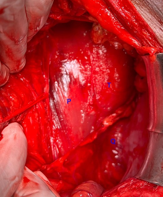 Intraoperative photograph showing the paravertebral location of the tumour posterior to the sympathetic chain (looped with an umbilical tape). T: tumour, P: Psoas, Q: quadratus lumborum.