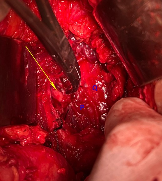 Intraoperative photograph after the tumour resection showing the cut end of the second lumbar nerve (arrow). P: Psoas Major, Q: quadratus lumborum.
