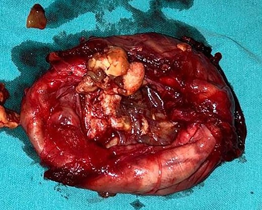 Photograph of the excised tumour showing cystic areas and areas of haemorrhages.