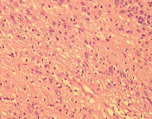 Low-resolution 200x H&E histopathology image of the tumour showing hypercellular (Antony A) areas.