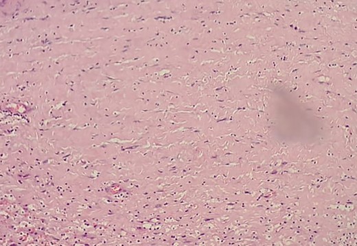 Low-resolution 200x H&E histopathology image of the tumour showing hypocellular (Antony B) areas.