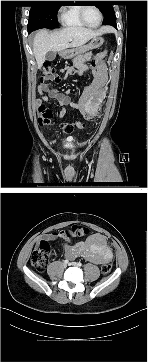 Coronal and axial views of CTA images of the abdomen and pelvis reveal a multilobulated heterogenous mass measuring 16.7 × 6.9 × 8.3 cm in the left mid-abdomen. Curvilinear foci of enhancement are visualized at its lateral aspect, originating from a prominent arterial vessel extending from the splenic artery.