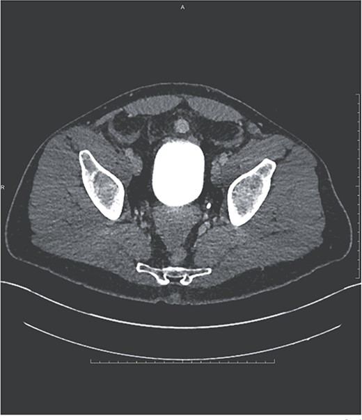 Ovoid hyperenhancing lesion anterior to the dome of the bladder, representing an additional area of splenosis.