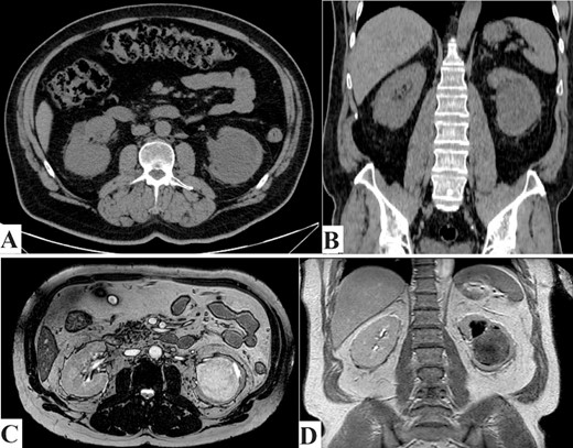 (A) CT scan axial section and (B) CT scan coronal section. Showing left kidney well-defined rounded soft tissue density mass lesions measuring about 6.7 cm in the lower aspect of the renal medulla. (C) MRI axial section, and (D) MRI coronal section. Showing left kidney large well defined rounded hypointense on T1W and heterogenous hyperintense on T2W images focus seen in the lower aspect of the medulla of the left kidney measuring about 6.8 cm approximately, resulting in mild calyceal dilatation.