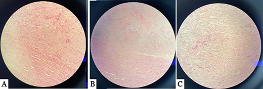 Multiple histopathology sections showing intrarenal neurofibroma with normal kidney tissues. (A) and (B) show the tumor located inside renal parenchyma, juxta to the renal cortical parenchyma. (C) The image show spindle cell tumor with serpentine wavy nuclei arranged in a fascicular pattern.