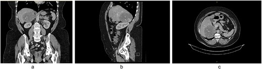 (a) CT coronal, (b) CT sagittal, (c) CT axial scans demonstrating a right-sided adrenal lesion (9.5 × 8.6 cm) with fat lobules, calcification and heterogeneous progressive enhancement.