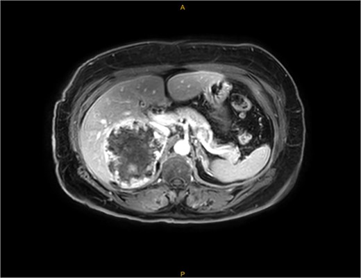 MRI—demonstrating peripheral enhancement in large, complex right-sided adrenal lesion (9.8 × 8.2 × 8.1 cm).