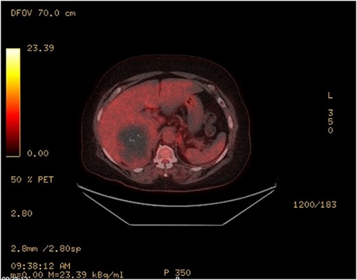 PET—large heterogenous complex right adrenal mass that measured up to 10 cm is largely photopenic with a mild peripheral rim of FDG accumulation (SUV max 3.4) at a level similar to adjacent physiologic hepatic activity.
