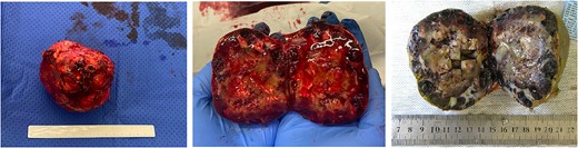 Macroscopic appearance with dilated blood-filled channels with tan-pale areas of fibrin, fibrosis, calcifications and haemorrhage (middle). With formalin fixation, these features are better appreciated (right).