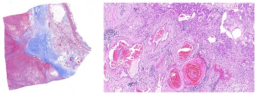 Left panel: low magnification (20×) of Masson’s trichrome stain highlighting fibrosis, fibrin and haemangioma in the adrenal cortex. Right panel: medium magnification (200×) of haematoxin- and eosin-stained section demonstrating variably dilated vascular changes filled with blood with variable hyalinization and fibrin in the wall.