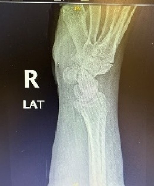 Hand and wrist x-rays pre-operatively.