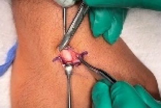 A dorsal approach of the quadrangular joint with excisional biopsy of the cystic lesion and bony lesion.