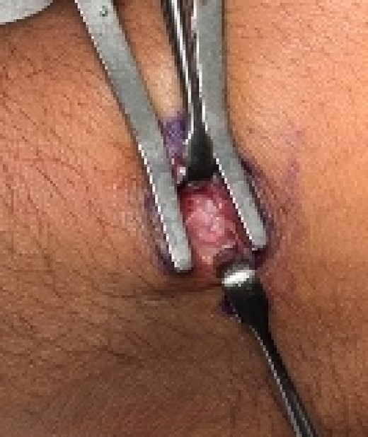 A dorsal approach of the quadrangular joint with excisional biopsy of the bony lesion.