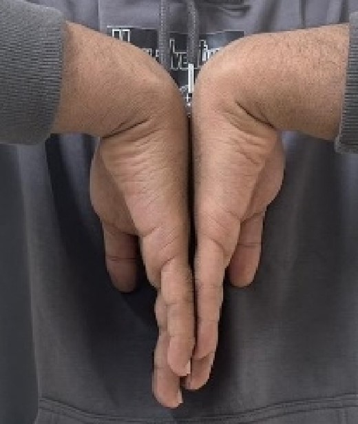 Hand and wrist range of motion 2 months post-operatively.