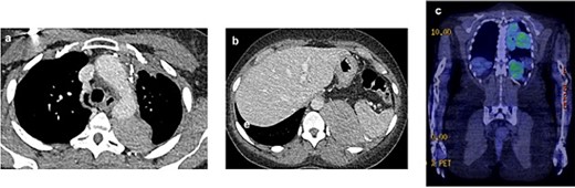 2021 PET and CT scan showing recurrence extension, involving the left parietal pleura (a, c) and the retroperitoneal tissue with spleen capsule (b).
