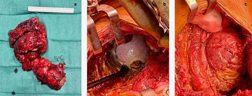 (a) Entire mass. (b) The tumor was attached to the splenic capsule, which was excised. Hemostasis was performed with Aquamantis (Medtronic®). (c) Pericardium after resection of tumor deposit.