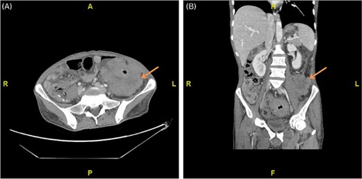 (A, B) Axial and coronal computed tomography (CT) scan showing marked non-uniform wall thickening and nodularity with heterogeneous enhancement invading the lateral part of the left psoas muscle and the left transverse abdominis muscle.