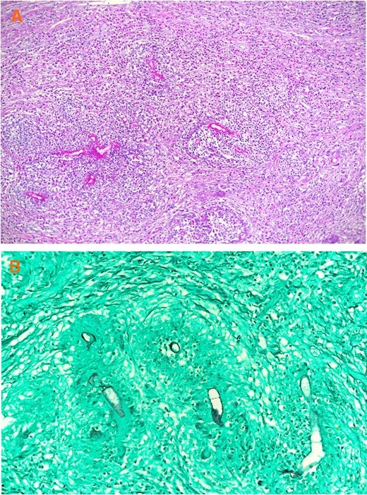 (A) Broad hyphae surrounded by eosinophilic material and a mixed inflammatory cell infiltrate containing multinucleated giant cells and numerous eosinophils. (A: H & E × 100), (B) Broad hyphae surrounded by eosinophilic material and a mixed inflammatory cell infiltrate containing multinucleated giant cells and numerous eosinophils. (B: GMS ×200).