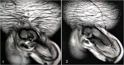 An MRI with (1) left corporeal tear on the left side with surrounding hematoma and (2) right corporeal tear with hematoma and disruption of urethra.