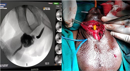 (1) On table RGU showing evidence of partial urethral disruption and (2) total transection of proximal urethra on exploration with penoscrotal vertical incision.