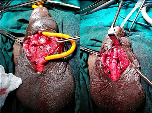 Reconstruction of midline septum with mobilized and anastomosed penile urethral ends.