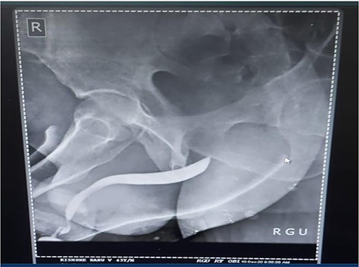 Follow-up RGU done after 3 months showing no evidence of stricture.