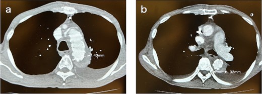 CT 5 days after the initial surgery revealed no endoleak and good remodeling of the descending aorta at the levels of the aortic arch (a) and the carina of the trachea (b).
