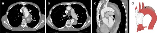 CT 6 months after the initial surgery reveals an endoleak from the fenestration (indicated by the white arrow), antegrade flow in the false lumen, and an enlarged aorta at the levels of the aortic arch (a) and the carina of the trachea (b). Sagittal image (c). An illustrative diagram (d) shows the schema of endoleak from fenestration (indicated by the black arrow).