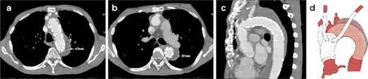 CT 3 months after redo surgery reveals no endoleak and no flow in the false lumen, and remodeling of the aorta at the levels of the aortic arch (a) and the carina of the trachea (b). Sagittal image (c). An illustrative diagram (d) shows the postoperative schema.