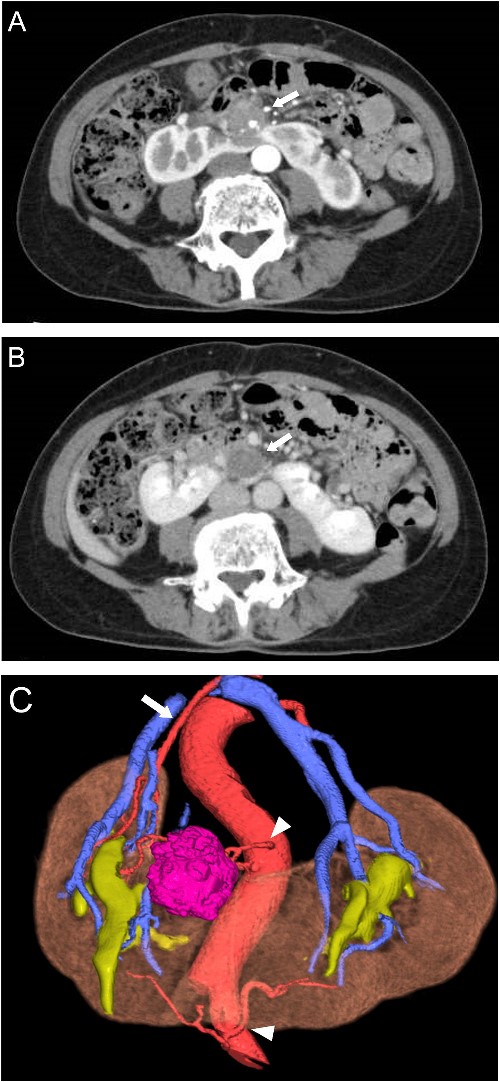Preoperative CT scans. (A) Contrast-enhanced CT showed heterogeneous enhancement of the tumor in the arterial phases (arrow). (B) The cystic area of the tumor had no enhancement in the venous phase (arrow). (C) 3D-CT demonstrated one artery arising from the aorta to the right kidney (arrow) and two arteries supplying the isthmus and tumor arising from the ventral side of the aorta and left common iliac artery (arrowhead).