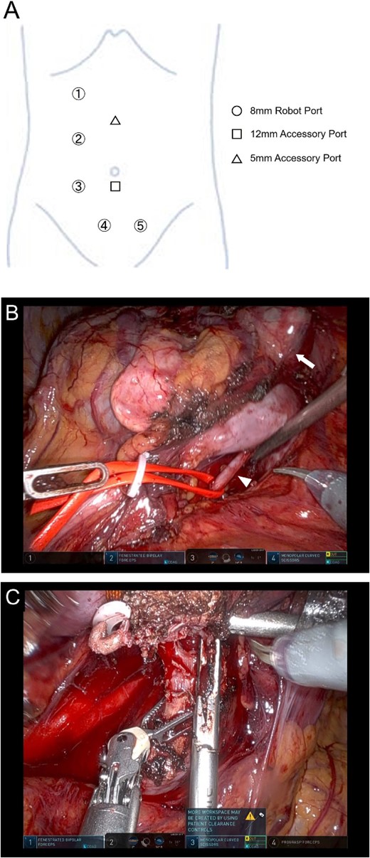 Position of the port for RAPN (A) and intraoperative findings of RAPN (B-D). (B) The dorsal side of the isthmus and artery were dissected with the number 4 port of the camera position. (C) The isthmus was transected with the number 3 port of the camera position.