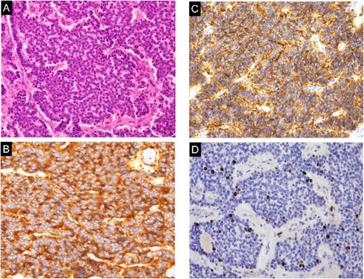 Histological and immunohistochemical examination of the specimen. A. The tumor was composed of small, round cells proliferating in a cord-like and ribbon-like papillary structure (hematoxylin and eosin staining; magnification, ×200). (B) The tumor cells were positive for synaptophysin (magnification, ×200). (C) The tumor cells were positive for CD56 (magnification, ×200). (D) The Ki-67 index was 4% (hematoxylin and eosin staining; magnification, ×200).