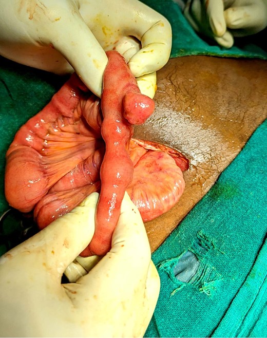 Intraoperative discovery of Meckel’s diverticulum during running of the bowels.