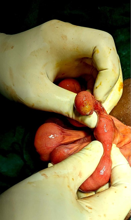 Bubbles coming out of the Meckel’s diverticulum during compression, suggesting perforation in the diverticulum.