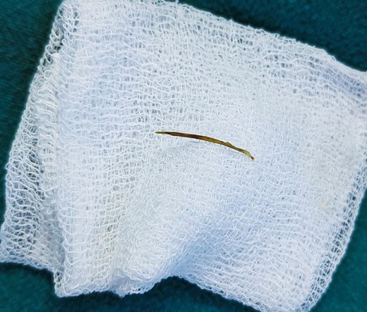 Fish bone revealed from the abdominal cavity.