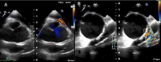 Transesophageal echocardiogram captured preoperatively shows a dilated sinus of Valsalva and mild central aortic valve regurgitation (A), and severe RVOT stenosis (B).