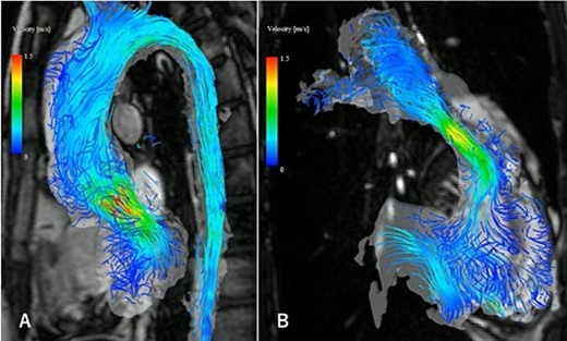 The four-dimensional flow magnetic resonance imaging revealed the presence of mild aortic valve regurgitation (A) and severe pulmonary valve regurgitation (B), with a regurgitant fraction of 34.4%.