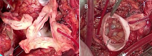 Intraoperative findings show that the aortic valve leaflets were preserved without any prolapse or calcification (A), and each commissure was aligned with the height of the sinotubular junction of the 26 mm Valsalva graft (B).