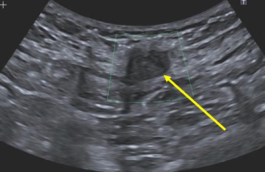 Hypoechoic, nonvascular, non-fluid-filled subcutaneous nodule (arrow), likely suture granuloma.