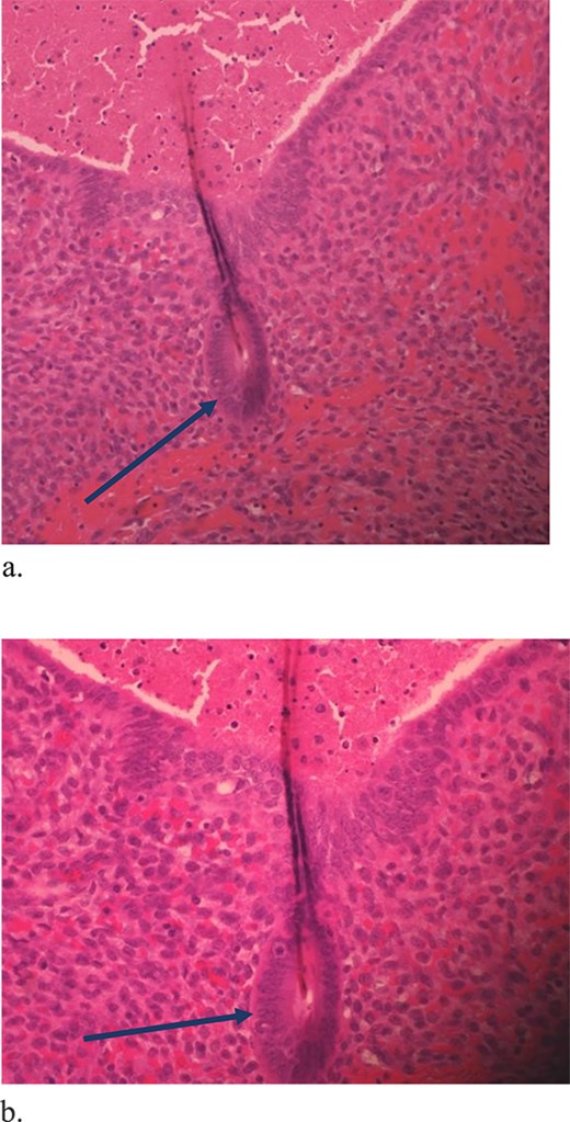 Proliferative endometrial gland (arrows) and stroma with hemorrhage in the lumen of the gland at 20× (a) and 40× (b) (H&E).