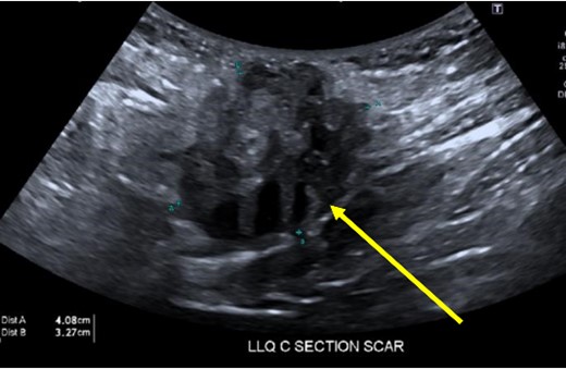 Heterogeneous, vascular nodule (arrow) measuring 4.1 × 3.3 × 4.4 cm, suggestive of endometrioma.