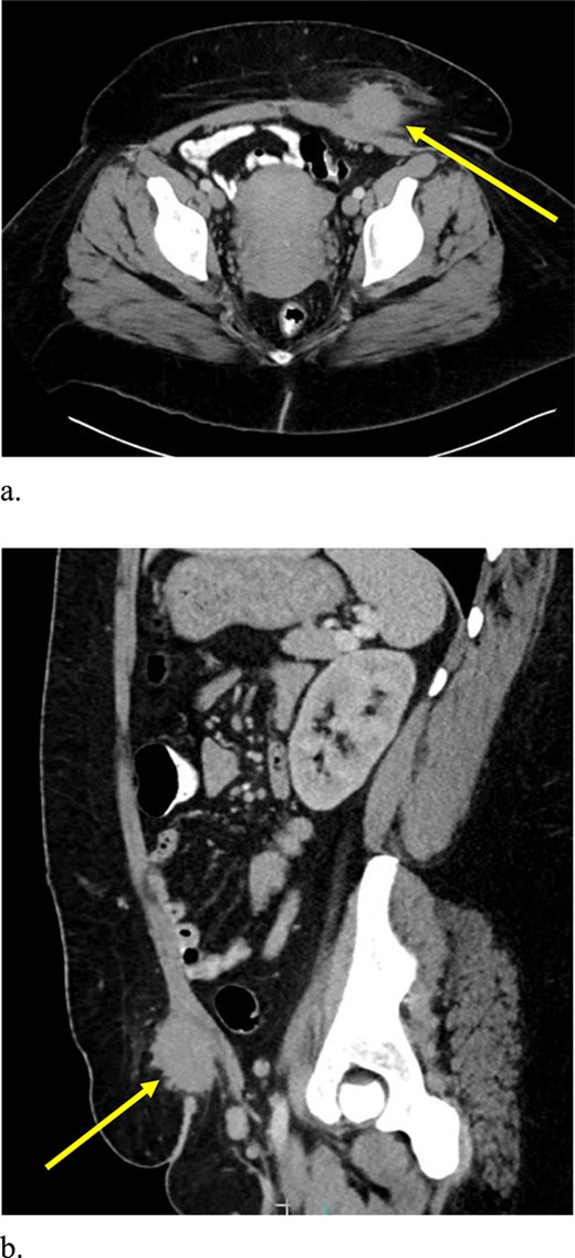 Computed tomography axial (a) and sagittal (b) views of a 4.2 × 4.1 × 3.7 cm enhancing, irregular mass on the abdominal wall (arrow) suggestive of AWE.