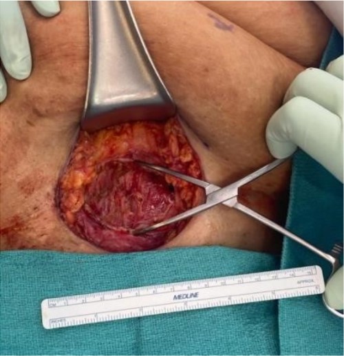 Defect in the abdominal wall after excision.