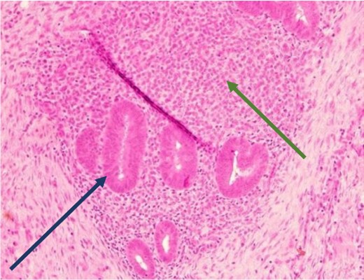 Low power view showing endometrial glands and stroma in abdominal wall tissue consistent with endometriosis (H&E).