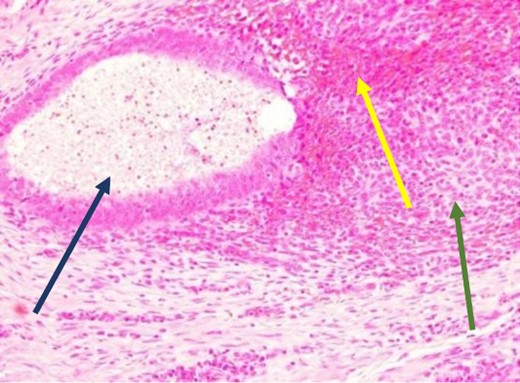 High power showing endometrial gland and stroma with hemorrhage consistent with endometriosis (H&E).